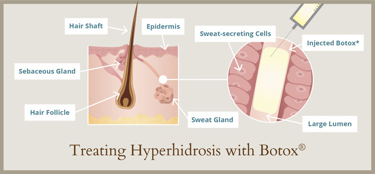 Hyperhidrosis 3