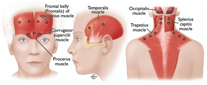 Migraines Botox 4