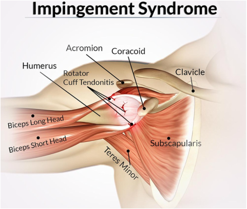 Shoulder Pain Impingement