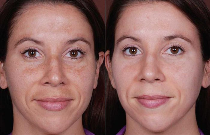 Melasma-Treatment-Rejuvayou-Medical