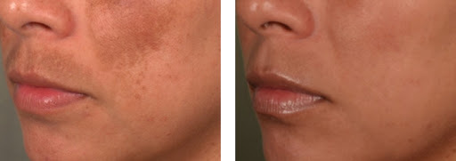 Melasma 6