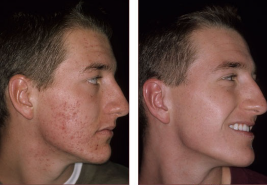 Chicken Pox Scars Best Treatment Face Surgery Alternative Scarring Before After Photos Los Angeles 5