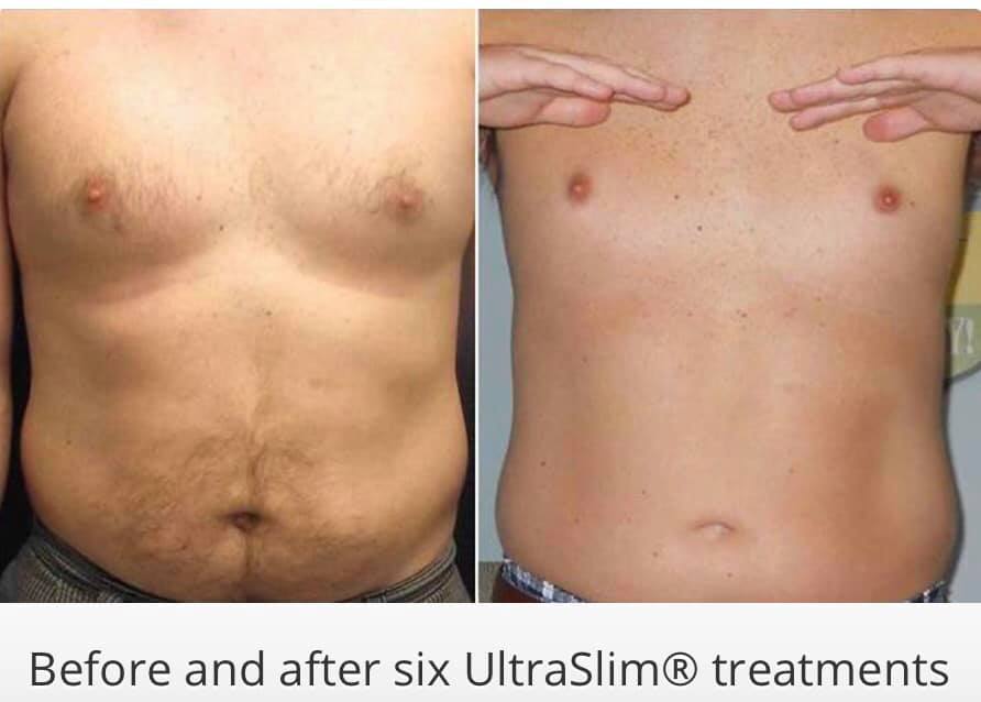 Ultraslim 11 Best Fat Reduction Loss Treatment Los Angeles Coolsculpting Lipo Alternative Proven Red Light Therapy