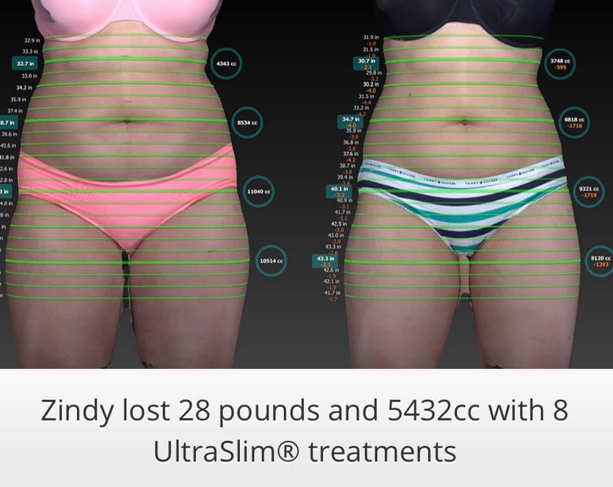 Ultraslim 7 Best Fat Reduction Loss Treatment Los Angeles Coolsculpting Lipo Alternative Proven Red Light Therapy