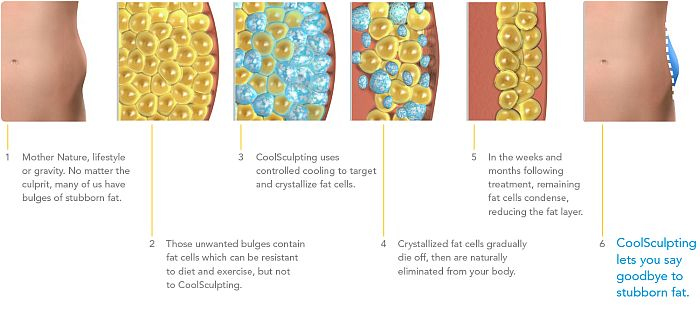 Coolsculpting Treatment Process Los Angeles