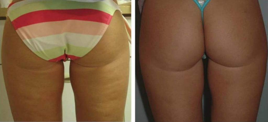 Cellulite Treatment Velashape Zwave Thermibody Los Angeles 1