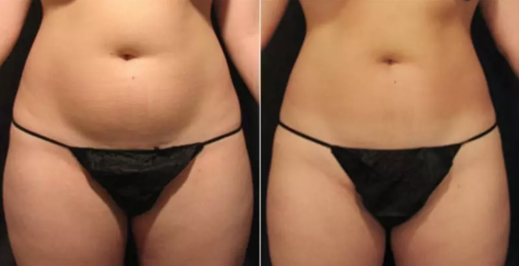 Cellulite Treatment Velashape Zwave Thermibody Los Angeles 3