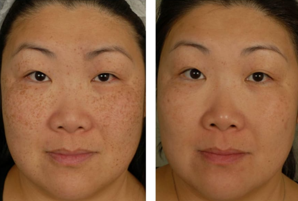 1a Ffrf Fotofacial Ipl Rf Photofacial Treatment Hyperpigmentation Los Angeles Pasadena Reduced Pigmentation Skin Rejuvenation Sunspots Brownspots Sundamage Redness Rosacea