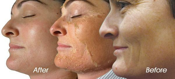 2 Peel 3 Phase Chemical Peel Benefits Treatment Tca Salycylic Acid Retinol Triple Rejuvemation Peel Los Angeles Pasadena