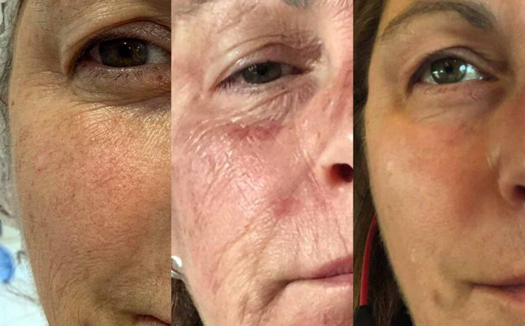 3 Peeling Process Chemical Peel Benefits Treatment Tca Salycylic Acid Retinol Triple Rejuvemation Peel Los Angeles Pasadena