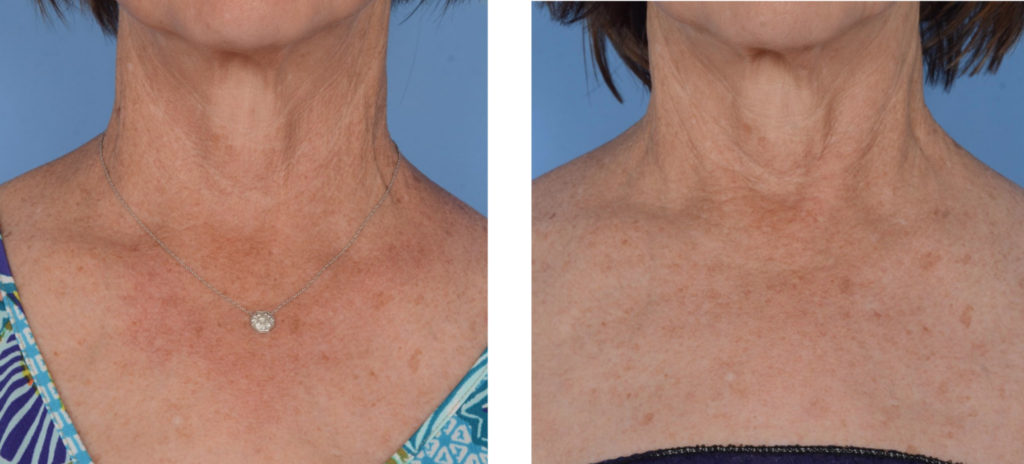 Ffrf Fotofacial Ipl Rf Photofacial Treatment Hyperpigmentation Los Angeles Pasadena Reduced Pigmentation Skin 1 Rejuvenation Sunspots Brownspots Sundamage Redness Rosacea Decollete