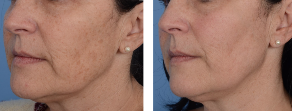 Ffrf Fotofacial Ipl Rf Photofacial Treatment Hyperpigmentation Los Angeles Pasadena Reduced Pigmentation Skin Rejuvenation Sunspots Brownspots Sundamage Redness Rosacea Side Face