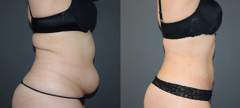 Laser Liposuction - Rejuvayou Laser Liposuction - Rejuvayou