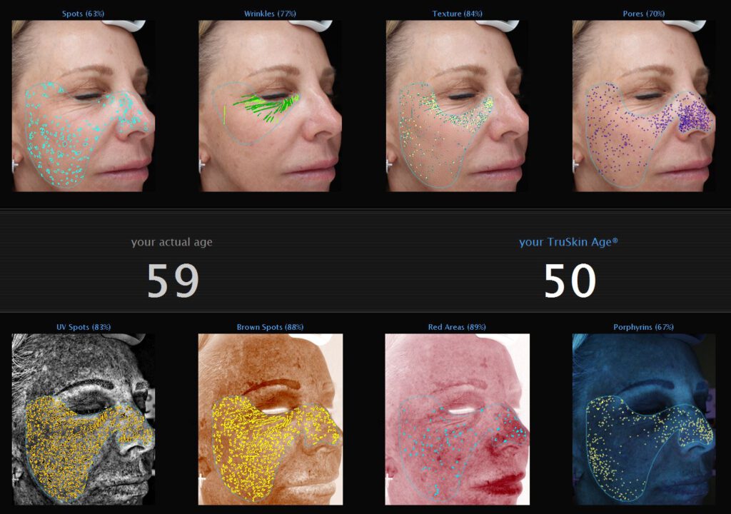 Visia Skin Analysis True Skin Report