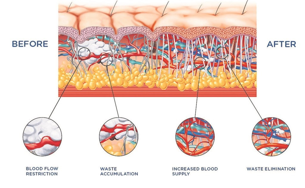 3 Shockwave Extracorporeal Therapy Los Angeles Pasadena Knee Pain Shoulder Pain Management Surgery Alternative