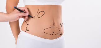 Laser Liposuction Los Angeles CA RejuvaYou Medical