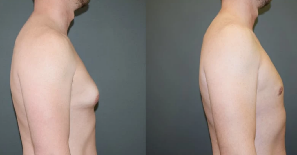 1 Laser Vaser Liposuction Liposculpture Body Sculpting Gynecomastia Treatment Male Breasts Los Angeles Pasadena