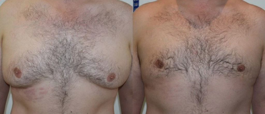 2 Laser Vaser Liposuction Liposculpture Body Sculpting Gynecomastia Treatment Male Breasts Los Angeles Pasadena