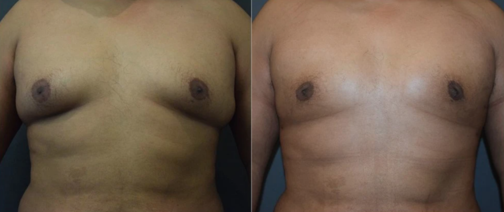 4 Laser Vaser Liposuction Liposculpture Body Sculpting Gynecomastia Treatment Male Breasts Los Angeles Pasadena