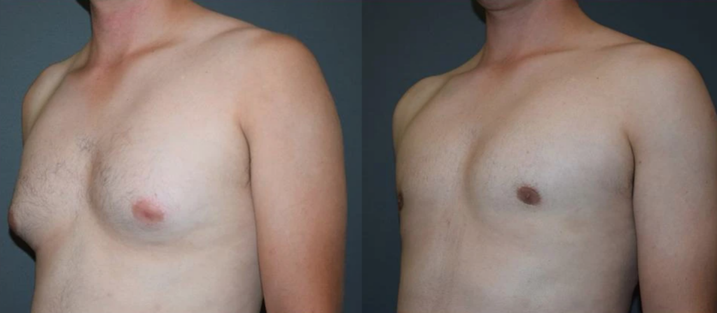 6 Laser Vaser Liposuction Liposculpture Body Sculpting Gynecomastia Treatment Male Breasts Los Angeles Pasadena