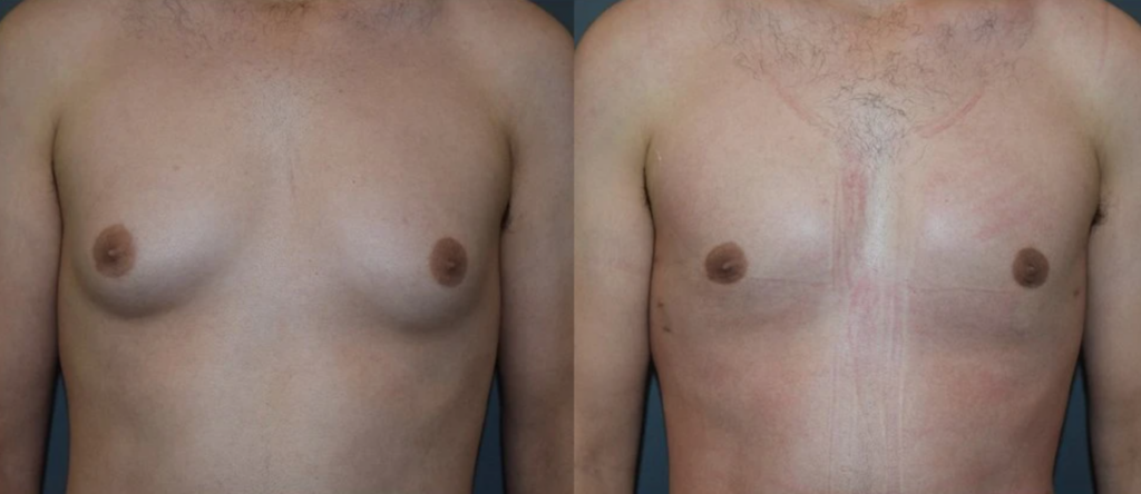 7 Laser Vaser Liposuction Liposculpture Body Sculpting Gynecomastia Treatment Male Breasts Los Angeles Pasadena