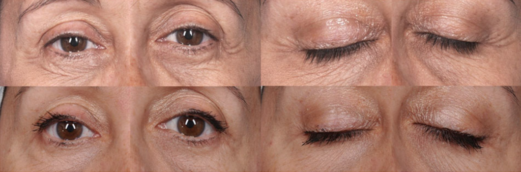 Thermismooth Skin Tightening Treatment Eyes Face Sagging Radiofrequency Thermi Before After Photo Los Angeles Pasadena