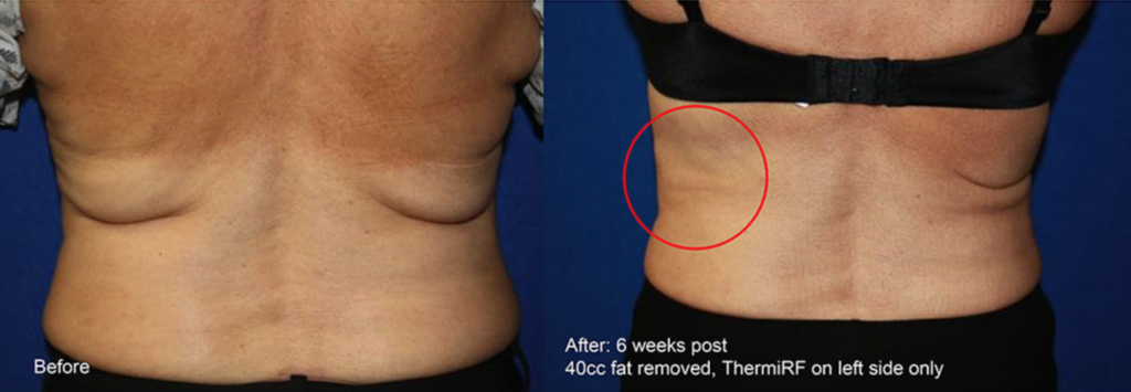 Thermitight Skin Tightening Treatment Body Flanks Radiofrequency Thermi Before After Photo Los Angeles Pasadena