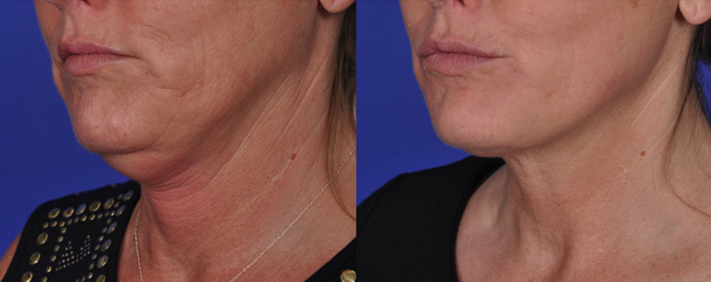 Thermitight Skin Tightening Treatment Face Neck Before After Photo Radiofrequency Thermi Los Angeles Pasadena