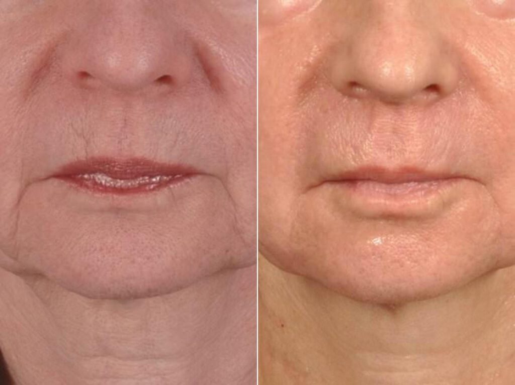 10 Microneedling Treatment Los Angeles Ca Pasadena Before After Photo Collagen Induction Therapy Acne Wrinkle Stretch Marks Chickenpox Scar Treatment