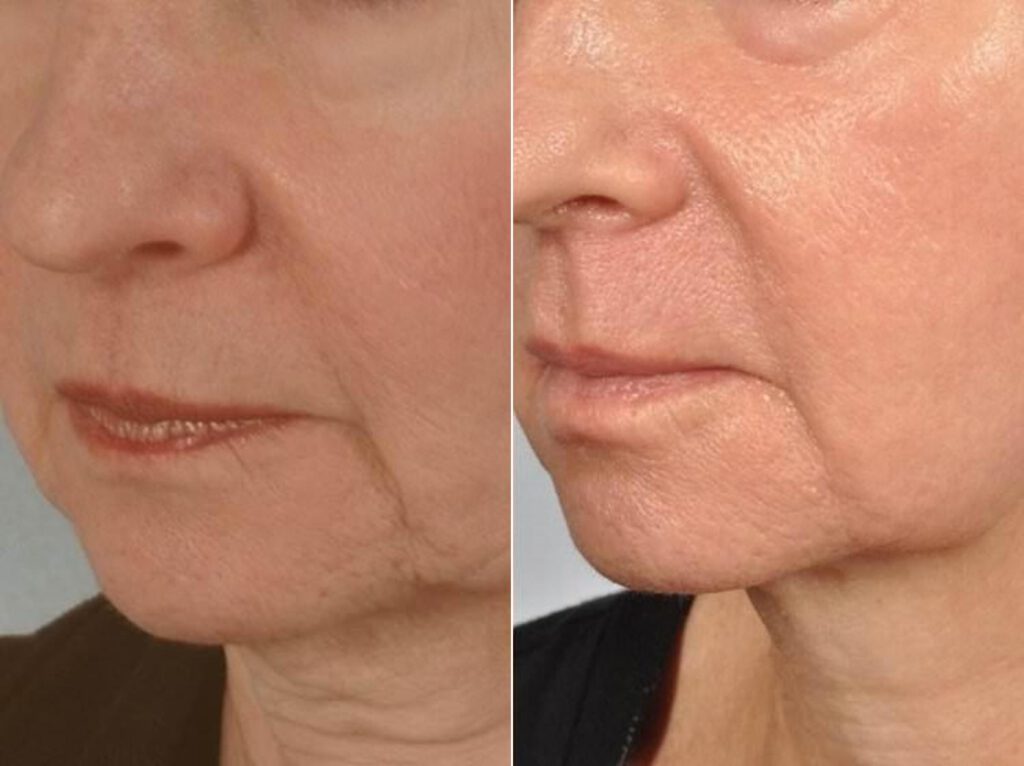 11 Microneedling Treatment Los Angeles Ca Pasadena Before After Photo Collagen Induction Therapy Acne Wrinkle Stretch Marks Chickenpox Scar Treatment