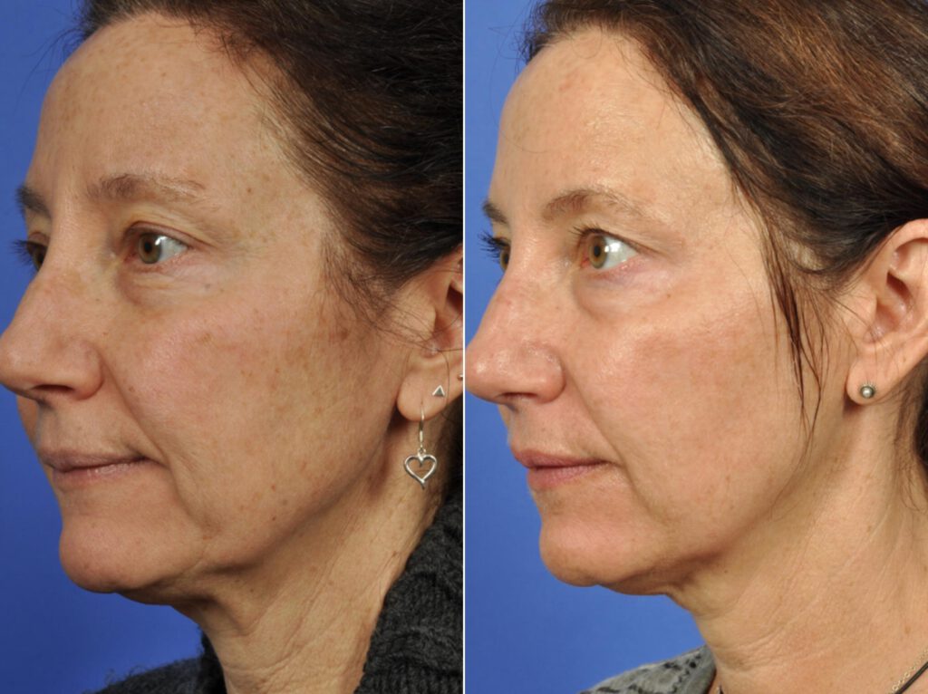 12 Microneedling Treatment Los Angeles Ca Pasadena Before After Photo Collagen Induction Therapy Acne Wrinkle Stretch Marks Chickenpox Scar Treatment