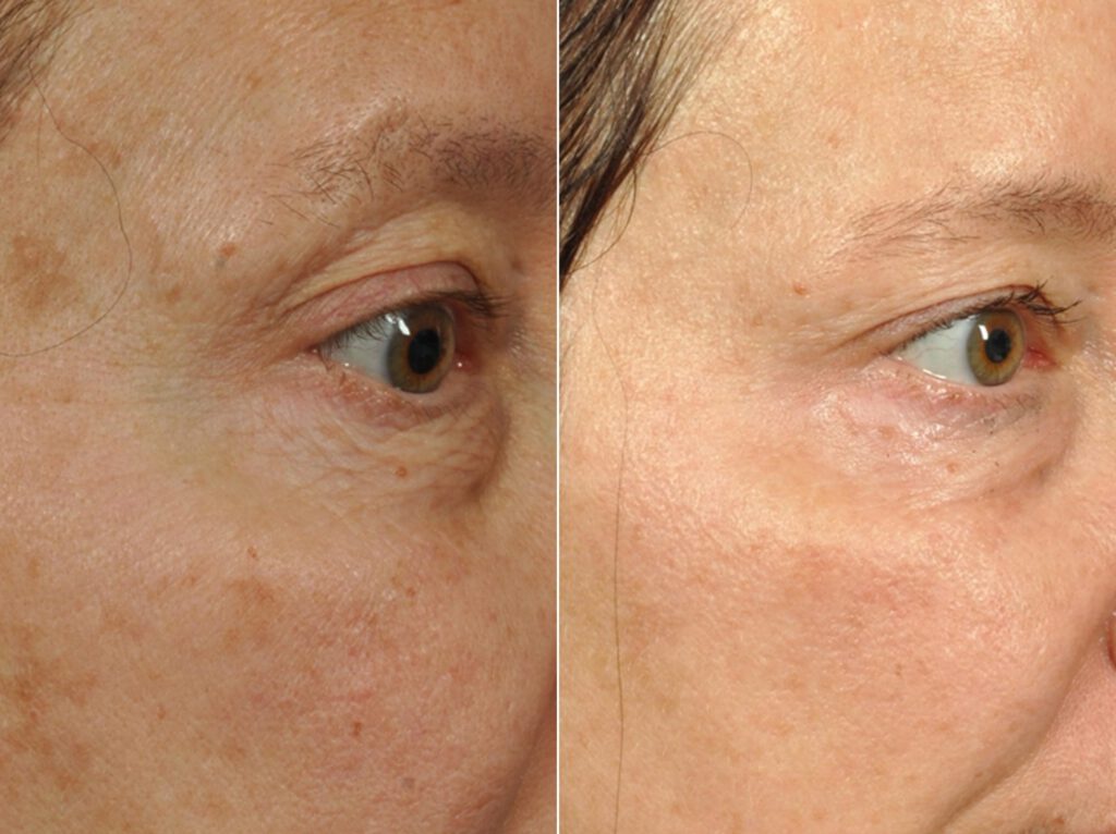 13 Microneedling Treatment Los Angeles Ca Pasadena Before After Photo Collagen Induction Therapy Acne Wrinkle Stretch Marks Chickenpox Scar Treatment