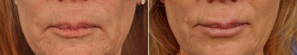 2 Microneedling Treatment Los Angeles Ca Pasadena Before After Photo Collagen Induction Therapy Acne Wrinkle Stretch Marks Chickenpox Scar Treatment