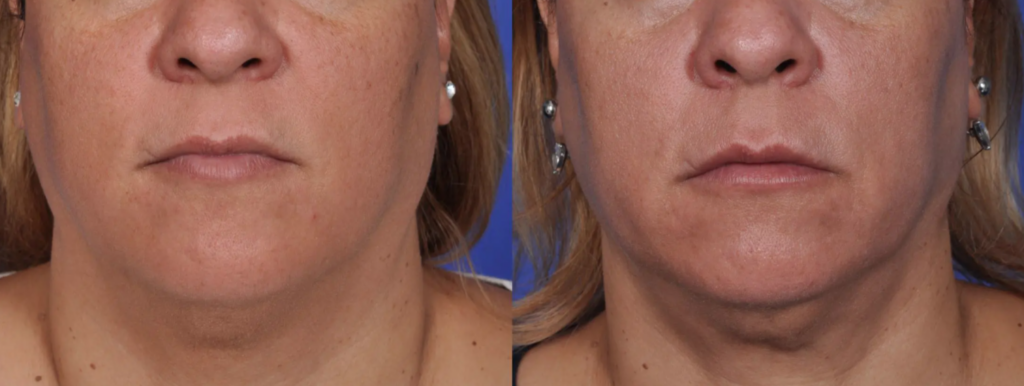 Face Neck Skin Tightening Thermi Smooth Thermismooth Treatment Los Angeles Pasadena Ca Ultherapy Thermage Alternative With No Pain