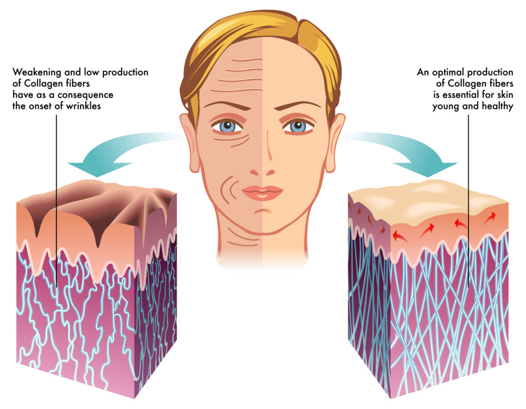 Graphic Infographic Microneedling Treatment Los Angeles Ca Pasadena Before After Photo Collagen Induction Therapy Acne Wrinkle Stretch Marks Chickenpox Scar Treatment