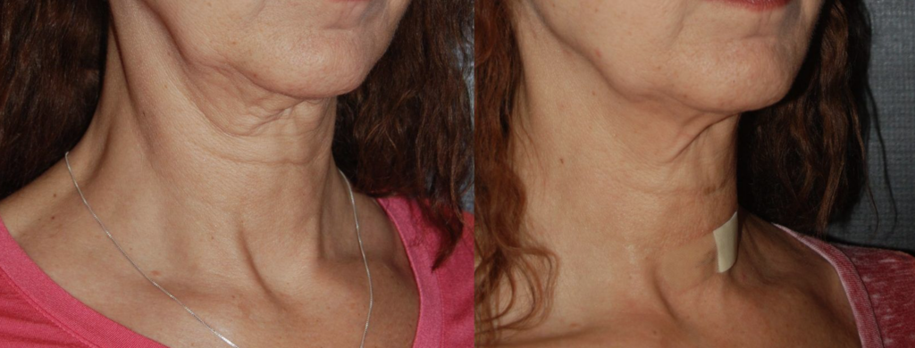 Neck Thermismooth Thermi Smooth Skin Tightening Treatment Face Neck Los Angeles Pasadena Ca Thermage Ultherapy Alternative