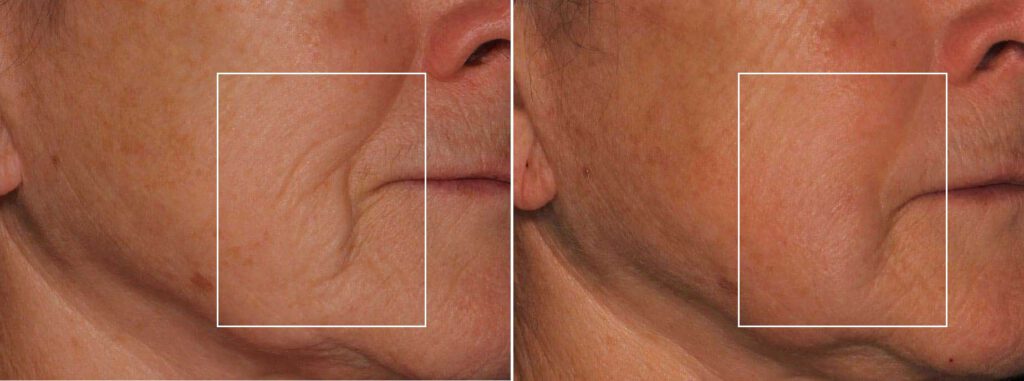 Sofwave Face Jowls Skin Treatment Los Angeles Pasadena Ca Alternative Thermage Ultherapy Before After