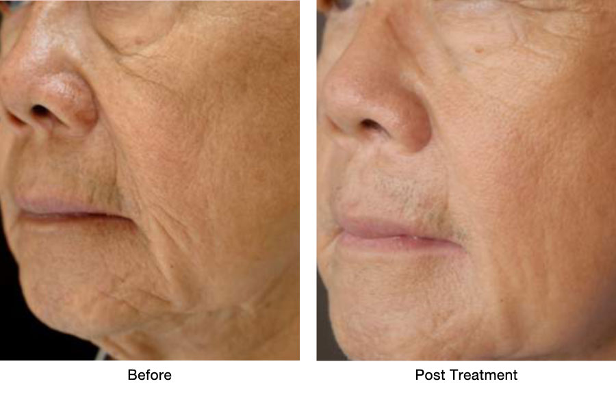 Sublime Skin Tightening Face Ultherapy Thermage Treatment Alternative Los Angeles Pasadena Ca