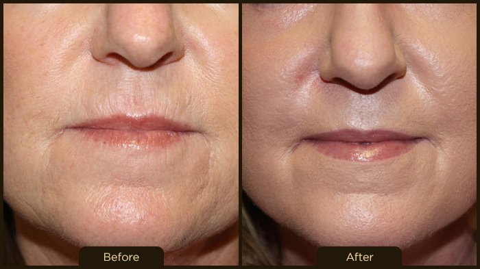 Thermismooth Thermi Smooth Skin Tightening Face Sagging Treatment Los Angeles Pasadena Ca