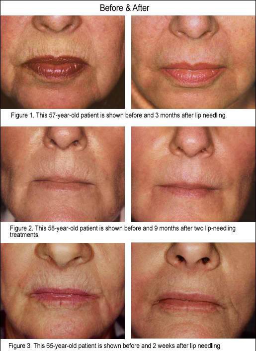 Dermapen Lip Wrinkles Microneedling Treatment Los Angeles Ca Pasadena Before After Photo Collagen Induction Therapy Acne Wrinkle Stretch Marks Chickenpox Scar Treatment