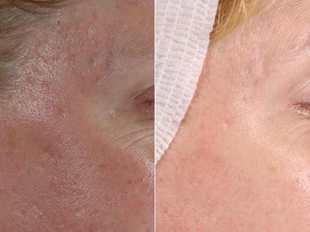 Microneedling Treatment Los Angeles Ca Pasadena Before After Photo Collagen Induction Therapy Acne Wrinkle Stretch Marks Chickenpox Scar Treatment