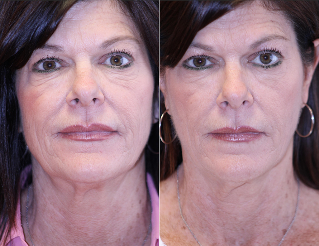 Sofwave 1a Before After Photo Face Skin Tightening Treatment Los Angeles Pasadena Ca