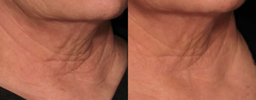 Sofwave 1a Before After Photo Neck Skin Tightening Treatment Los Angeles Pasadena Ca