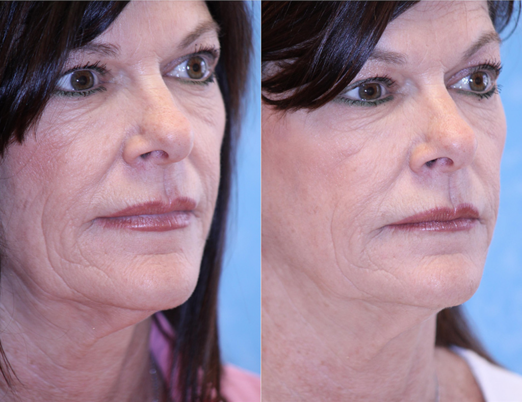 Sofwave 1b Before After Photo Face Skin Tightening Treatment Los Angeles Pasadena Ca