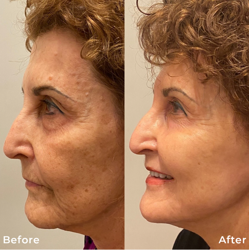 Co2 Fractional Laser Skin Resurfacing Treatment Carbon Dioxide Before After Photo Pic Los Angeles Pasadena Ca Skin Rejuvenation 1