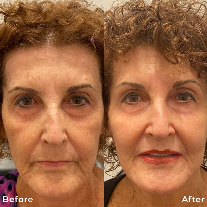 Co2 Fractional Laser Skin Resurfacing Treatment Carbon Dioxide Before After Photo Pic Los Angeles Pasadena Ca Skin Rejuvenation 1a