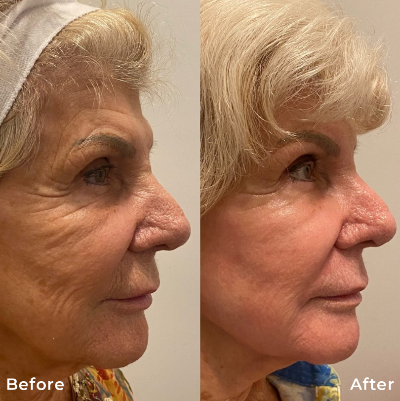 Co2 Fractional Laser Skin Resurfacing Treatment Carbon Dioxide Before After Photo Pic Los Angeles Pasadena Ca Skin Rejuvenation 5