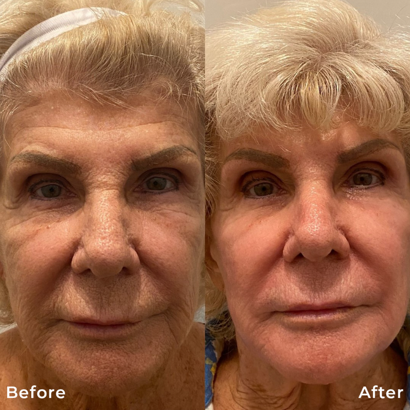 Co2 Fractional Laser Skin Resurfacing Treatment Carbon Dioxide Before After Photo Pic Los Angeles Pasadena Ca Skin Rejuvenation 6