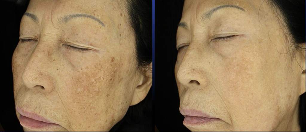 Nouvaderm - Before and After Photo