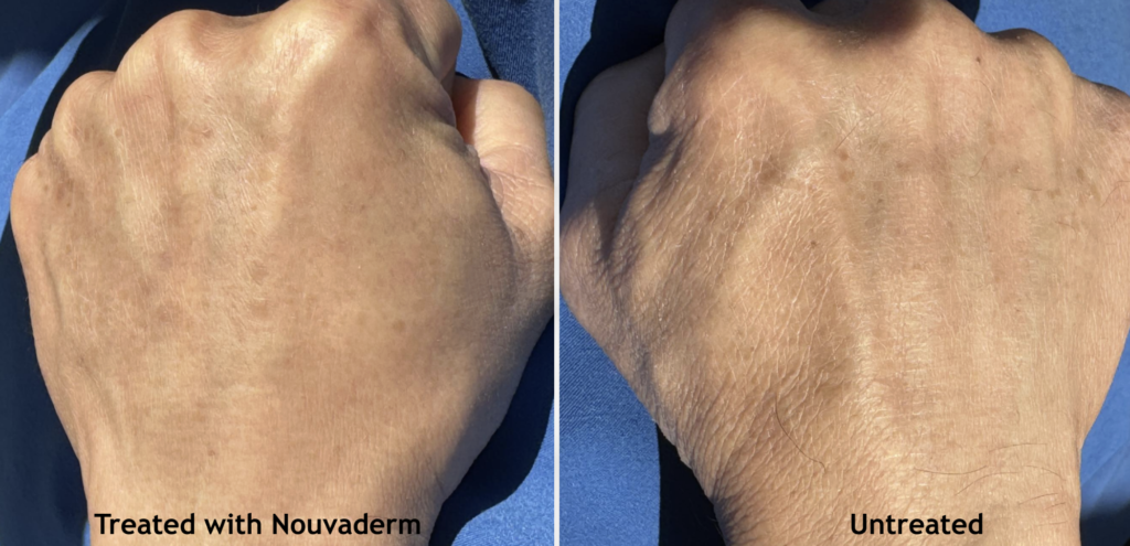 Nouvaderm - Before and After treatment